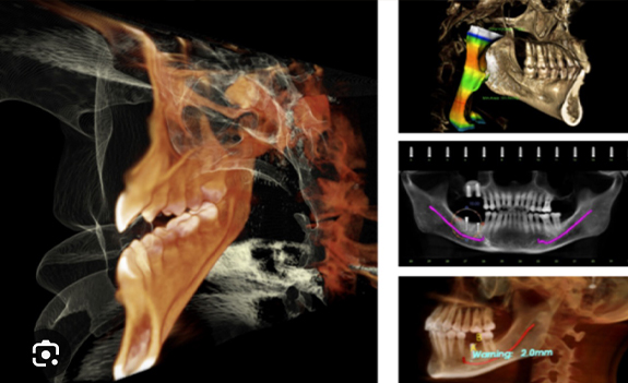 Several 3 D models of the jaws